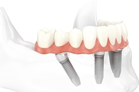 All On Four Implant Retained Dentures illustration