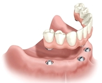 All On Four Implant Retained Dentures illustration