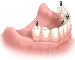 All On Four Implant Retained Dentures illustration